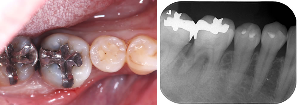 初診時の口腔内