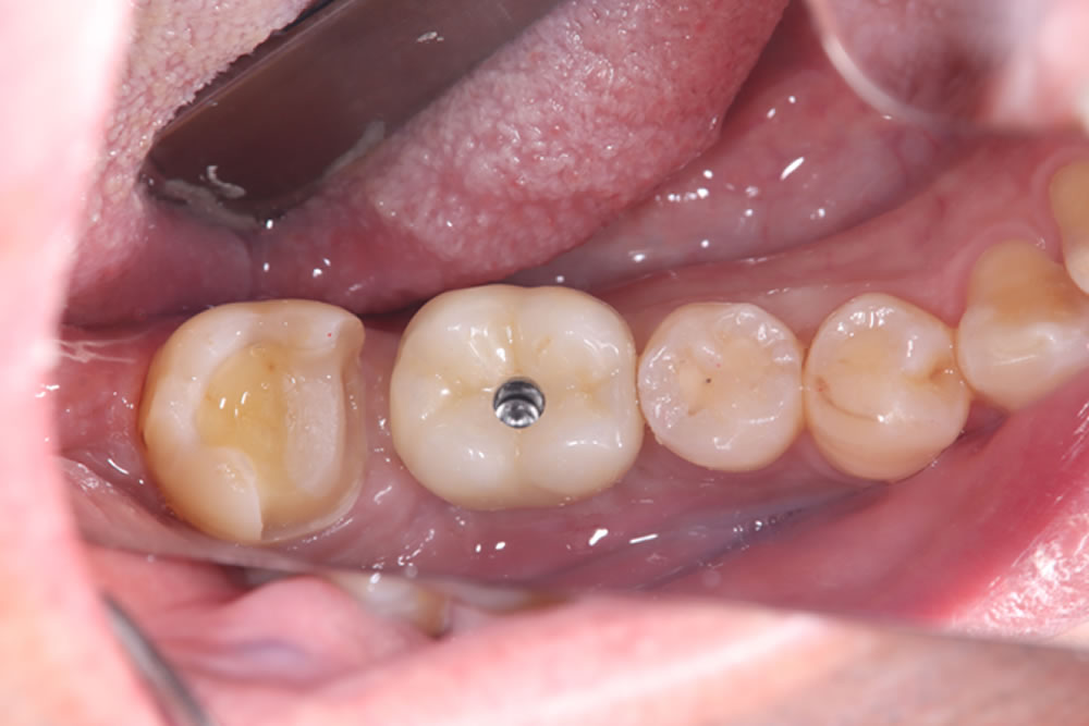 上部構造の装着