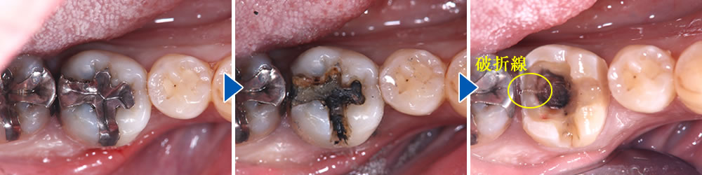 メタルインレーの除去