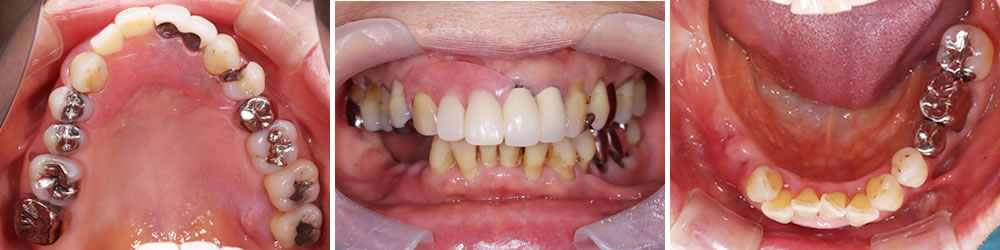 初診時の口腔内