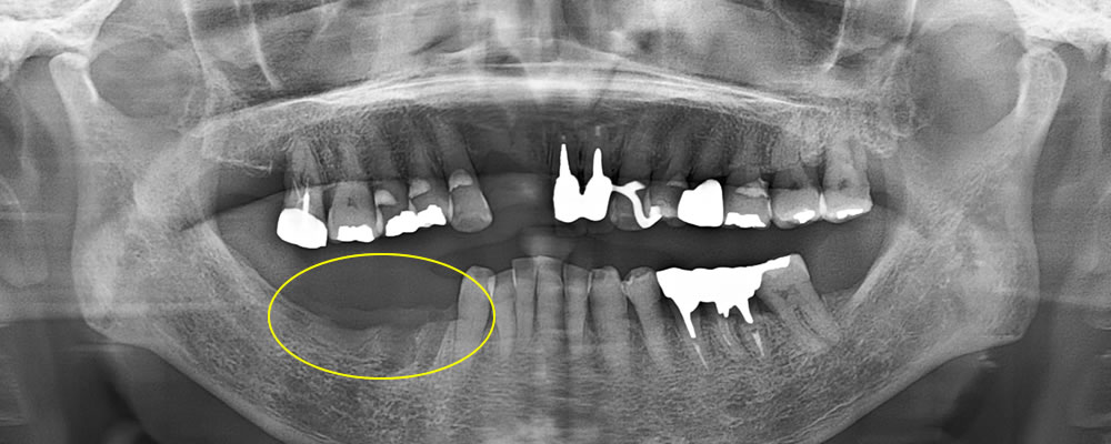 初診時のレントゲン画像