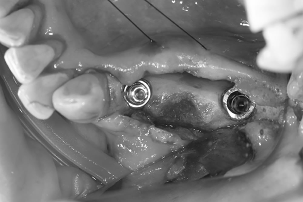 インプラントを埋入