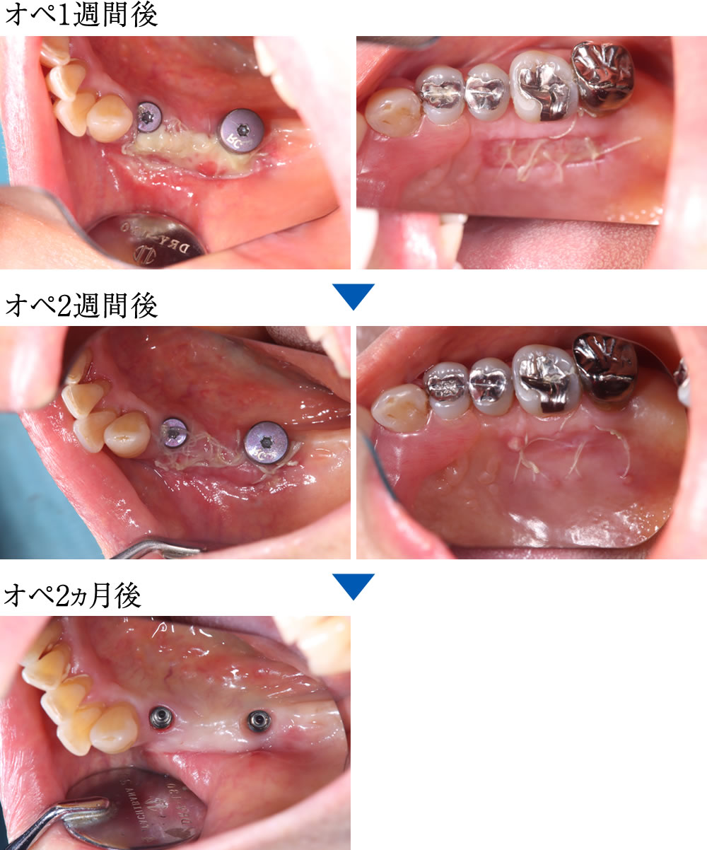 FGG(遊離歯肉移植術)の経過