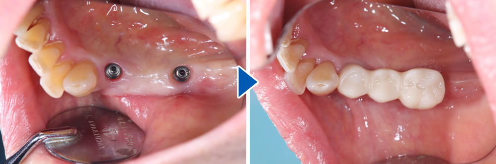 プロビジョナル(精密仮歯)装着