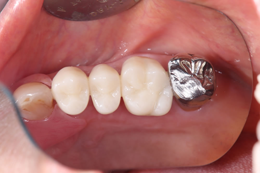 プロビジョナル装着