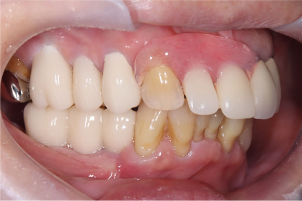 上下顎にプロビジョナル(精密仮歯)装着完了