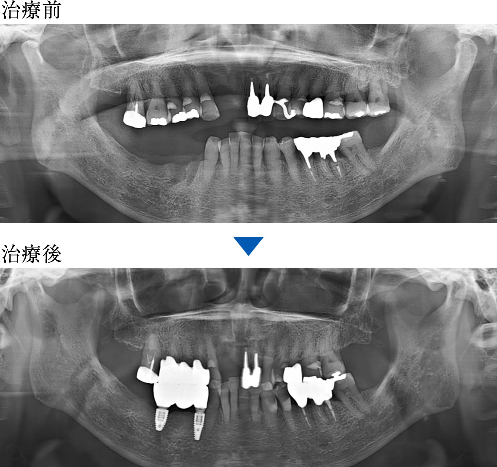 治療前後のレントゲン画像