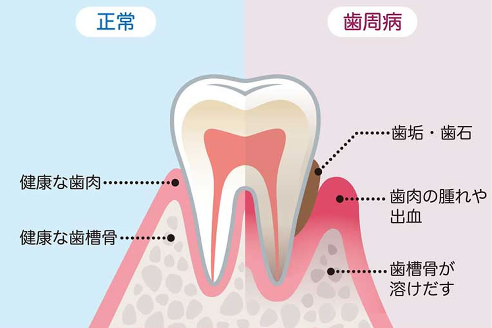 インプラント治療と歯周病治療の併用