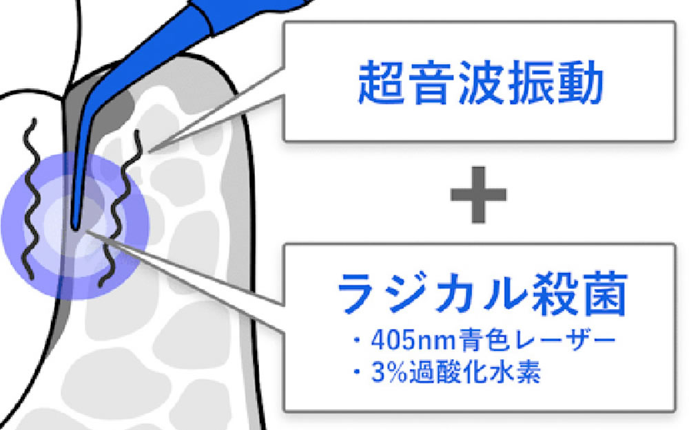 ブルーラジカルによる歯周病治療